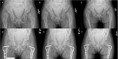 Postoperative Immobilization After Hip Reconstruction in Cerebral Palsy: No Difference Between Hip Spica and Abduction Pillow